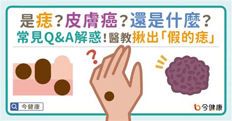 腋下長痣|是痣？還是皮膚癌？皮膚科醫師教你揪出「假的痣」，。